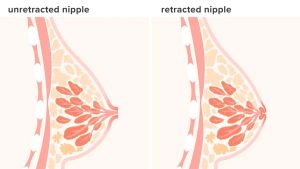 nipple retraction